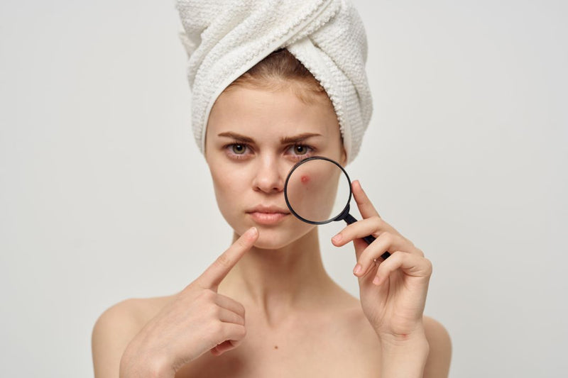 How To Handle Acne-Prone Skin in Dubai